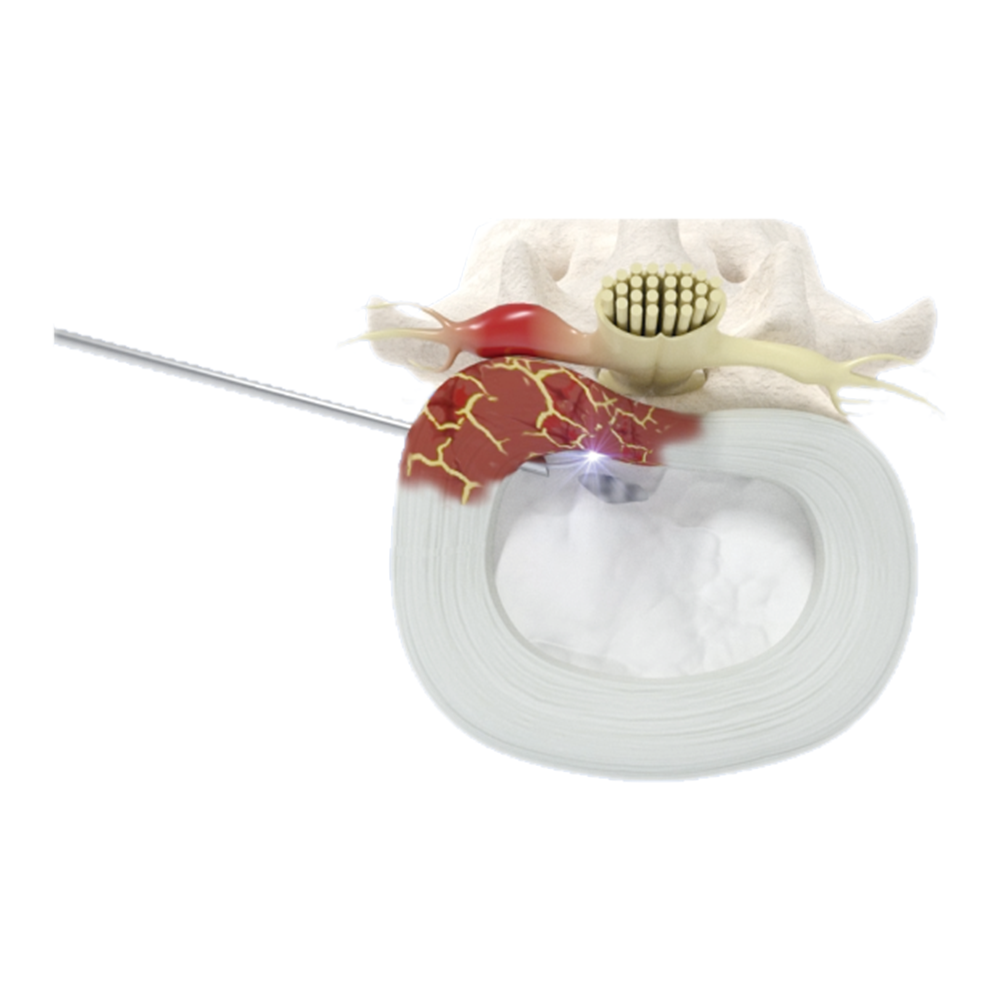 Percutaneous Disk Decompression Device (RF Curer)